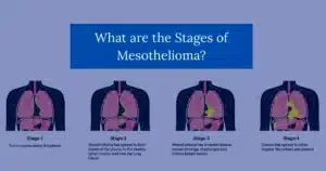 What are the Stages of Mesothelioma