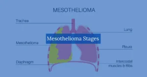 Mesothelioma Stages