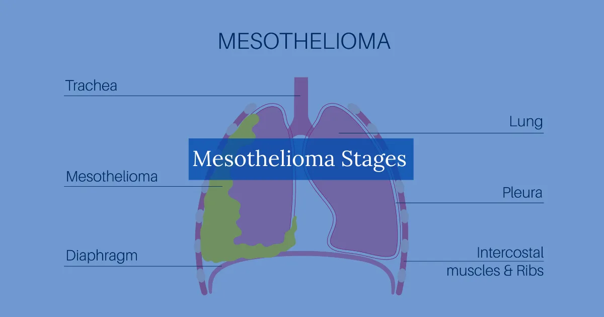 Mesothelioma Stages