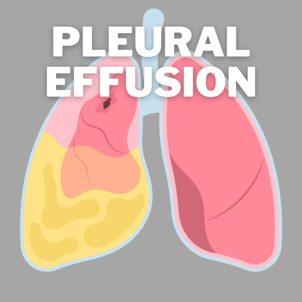 pleural effusion